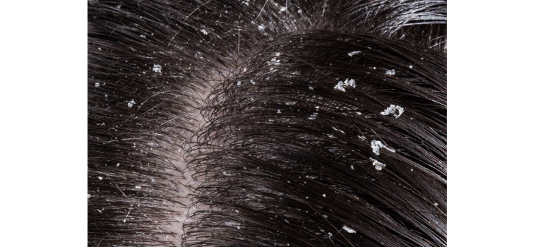 Ce que tous les gens qui ont des pellicules ne savent pas